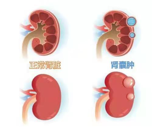 31121af468dee5e666cd113ee740a24d.jpeg Normal kidney and renal cyst. jpeg