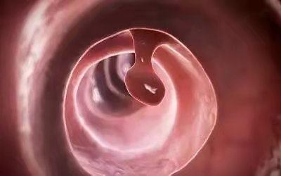 63ca289a458c939c9eecc0f40cb8f9fc.jpeg Intestinal polyps. jpeg