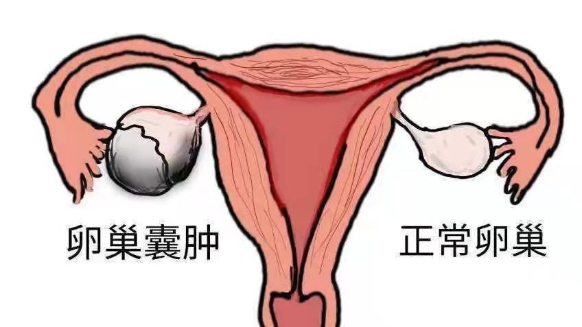 933b38e8aec81ff22dd18b0c06c7a0ee.jpeg Normal ovaries and ovarian cysts. jpeg